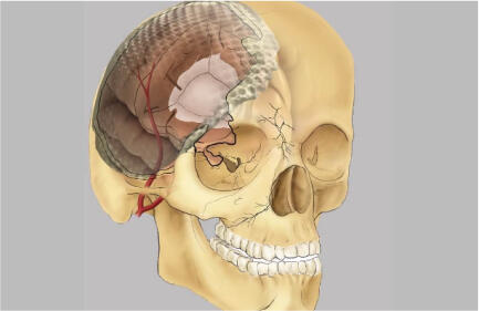 a graphic depicting an injury to a skull